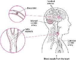 10 conseils pour éviter l'avc. Accident Vasculaire Cerebral Ischemique Troubles Du Cerveau De La Moelle Epiniere Et Des Nerfs Manuels Msd Pour Le Grand Public