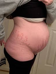 Image result for pruritic urticarial papules and plaques of pregnancy