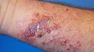The general attributes of ficin and its enzymic action have not been thoroughly described in the literature. Phytophotodermatitis Symptoms Causes And More