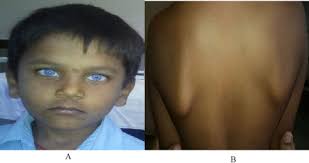 Case of Waardenburg Shah syndrome in a family with review of literature