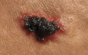 The bruised place looks red and swollen at first. Skin Cancer