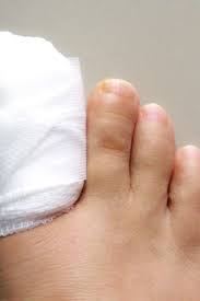 Image result for Toenail Removal