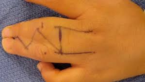 Poland syndrome was named for the investigator (poland a) who initially described the condition in 1841. Children With Congenital Hand Anomalies Malformations Healthychildren Org