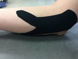 The standard white athletic tape that athletes and trainers have used for decades is made from stiff cotton that can help immobilize or stabilize an injured body part. Kinesiology Taping For Medial Epicondylitis