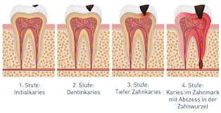 Besteht ein loch im zahn, bedeutet das, dass ein zahn von karies befallen ist. Karies Ursachen Symptome Behandlung