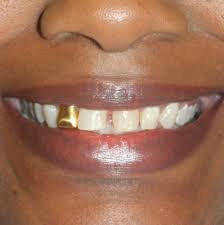 Permanent gold teeth can cost as little as $1,000 up to about $5,000 for a full top and bottom front set. Cerec Crown In A Day Dentist In Arlington Tx
