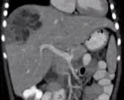 Image result for Liver Abscess