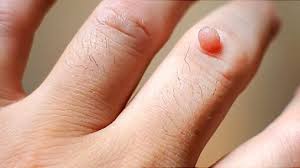 Explore tweets about #ketuat on twitter. Cara Menghilangkan Kutil Dengan Bahan Alami Gunakan Bawang Putih Hingga Madu Propolis Tribunnews Com Mobile