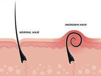 Learn why your hair changes during pregnancy and what you can do about it! 17 In Grown Hair Ideas Ingrown Hair Remedies Ingrown Hair Bikini Ingrown Hair