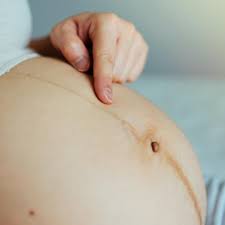 A veces acumulamos grasa en la barriga haciendo que nuestro torso se vea flácido y menos liso. Que Es La Linea Alba Y Por Que Aparece Baby Suite By Pau