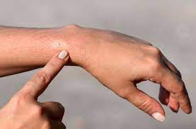 Allergies Causes And Risk Factors