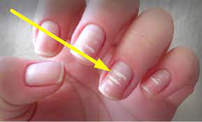 Manchas blancas en las uñas. Las Manchas Blancas En Las Unas Por Que Aparecen