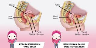 Sebahagian dari rahim telah terkelur dari vagina.pada peringkat ini wanita mungkin akan berasa. Jangan Bagi Perempuan Angkat Berat Sangat Nanti Jatuh Peranakan Pesona Pengantin