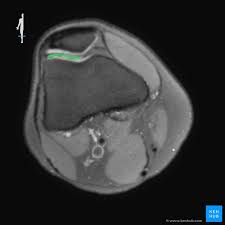 Cross sectional anatomy of the knee based on mri : How To Read The Normal Knee Mri Kenhub