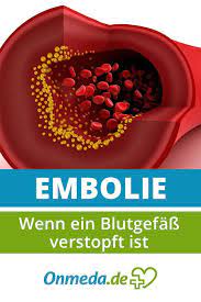 Embolie Definition Symptome Ursachen Behandlung Onmeda De Gesundheit Und Fitness Erkrankungen Krankheit