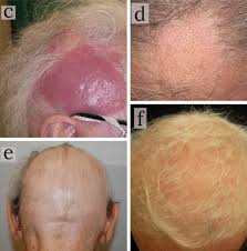 Dr. Donovan's Hair Loss Articles (2011-2024) — Donovan Hair Clinic