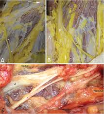 The lateral cutaneous nerve of the thigh (also called the lateral femoral cutaneous nerve) is a cutaneous nerve that innervates the skin on the lateral part of the thigh. The Lateral Femoral Cutaneous Nerve Canal In Journal Of Neurosurgery Volume 126 Issue 3 2017