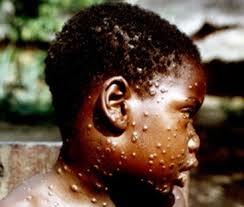 The time from exposure to onset of symptoms is around 10 days. Monkeypox Outbreak Toolbox