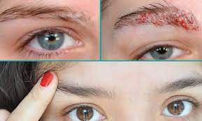 This condition develops when the immune system of the body attacks hair follicles. Why Itchy Eyebrows Causes And Treatment Inebra