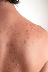 Image result for Diffuse Hyperpigmentation