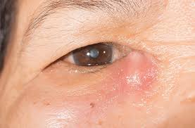 Image result for Dacryoadenitis