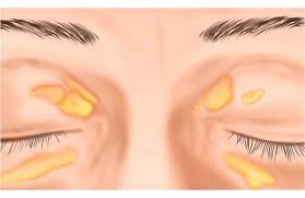 Image result for xantelasma