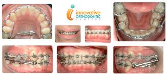 Lumbar back braces work by supporting your spine and surrounding muscles during times of pain and injury. Appliances Innovative Orthodontic Centers