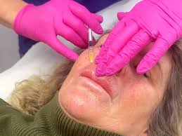 Lip Filler Migration: Causes & Prevention - Youtube