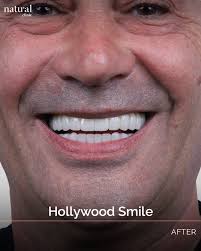Bright, beautiful, and natural—just how a Hollywood Smile should be!  Another perfect transformation at Natural Clinic. 😍 Your journey to  confidence starts here! Book your consultation today. 📩💙 📞 Phone: +90 212