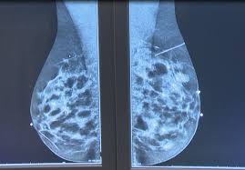 Microcalcifications, which look like white specks on a mammogram. Breast Imaging Specialist Talks Screenings Self Breast Exams Breast Cancer Risk Factors 9 10 News