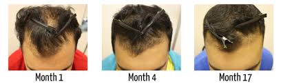 It works by increasing blood flow to the scalp and can cause the hair follicles to be revitalized. High Strength Minoxidil