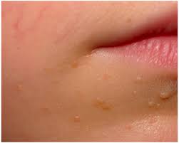 Yes, why not, but i advise to consume small quantity, as too much of ac vinegar can make you feel nauseating and you might end up vomiting out everything. Online Learning Module Benign Skin Lesions Molluscum Contagiosum Warts Flashcards Quizlet