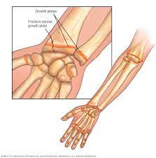 Growth Plate Fractures - Symptoms And Causes - Mayo Clinic
