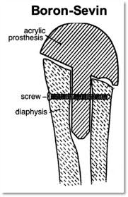 Image result for Shoulder History