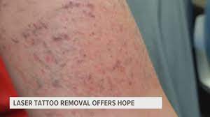 We did not find results for: Laser Tattoo Removal Offers Hope For Future Fox43 Com