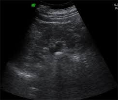 Image result for Nephrolithiasis Imaging