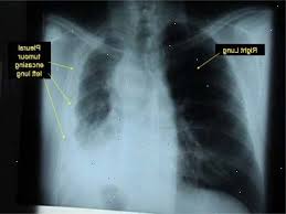 I have published papers on biomarkers . Mesothelioma Speqk