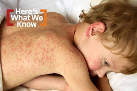 Image result for measles