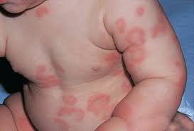 Image result for dermatitis contacta children