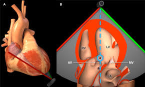 Image result for Left Ventricular Outflow Obstruction
