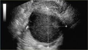 Grade 1 epithelial ovarian carcinomas look more these cysts usually go away within a few months without any treatment. The Radiology Assistant Ovarian Cystic Lesions
