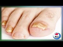 Hongos En Las Uñas De Las Manos Como Eliminarlos Como Eliminar Hongos En Las Unas Hongos En Las Unas Eliminar Hongos De Las Unas Cura Hongos En Las Unas