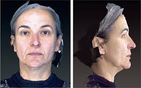 Previsão de variáveis e prevenção de resultados subótimos no  rejuvenescimento cirúrgico de face e pescoço: avaliação pré-operatória  sistemática com exame físico e ecografia