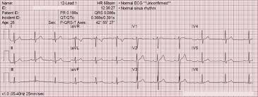 The Six Step Method For 12 Lead Ecg Interpretation Ems 12 Lead Ecg Interpretation Interpretation Method