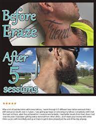 Tattoo removal is now more safe and affordable than it once was. Best Laser Tattoo Removal Gold Coast L Eraze Laser Clinic