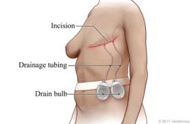 Image result for Mastectomy