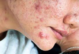 Новые интересные факты из жизни c. Acne O Que E Causas Tipos Graus Tratamento Prevencao Cura