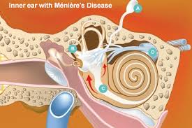 Image result for Inner Ear Decompression Sickness