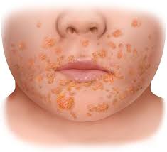 Image result for Impetigo