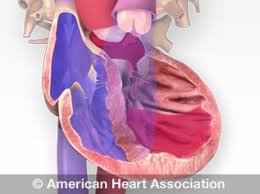 Image result for Right Heart Failure